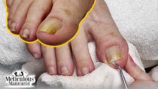 Why Are My Toenails Yellow? Appearance Causes + Fixes