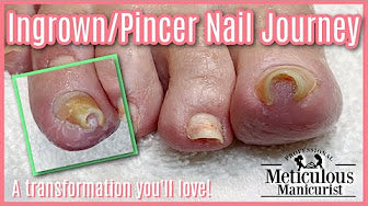 How to Fix an Ingrown Toenail at Home (Non-Medical Care Tips)
